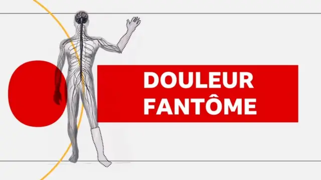 Douleur fantôme