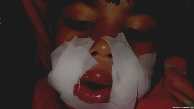 ਮੇਰਠ ਵਿੱਚ ਇੱਕ ਬੱਚੀ ਦੇ ਮੂੰਹ ਵਿੱਚ ਪਟਾਕਾ ਰੱਖ ਕੇ ਸਾੜਿਆ ਗਿਆ।