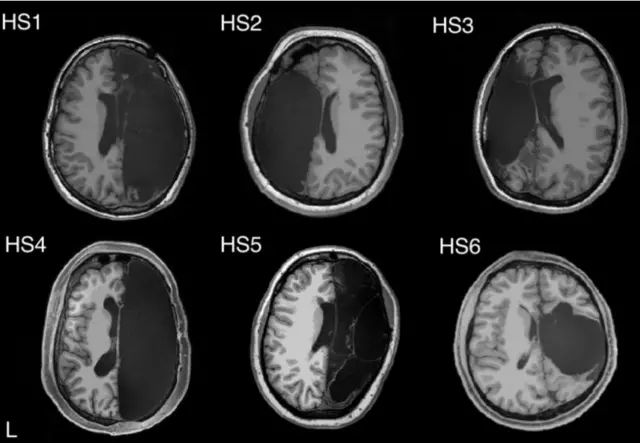 ภาพสแกนสมองครึ่งซีกของกลุ่มทดลอง 6 คน ซึ่งผ่านการผ่าตัดเอาเนื้อสมองออกซีกหนึ่งในวัยเด็ก