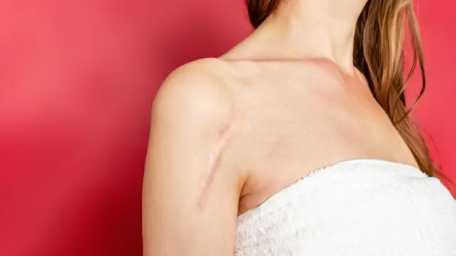 Mujer mostrando una cicatriz en la parte superior del brazo. 