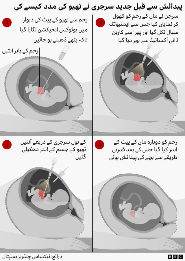 Infographic showing a four-step prenatal surgery. The foetus is given a Botox injection in the abdominal wall to relax the muscles, surgeons temporarily open the womb and use keyhole surgery to move a foetus’s intestines back inside the body before returning the uterus, allowing the pregnancy to continue until the healthy baby is born naturally.