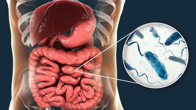 صورة بالكمبيوتر توضيحية لإصابة الأمعاء الدقيقة بالكوليرا.