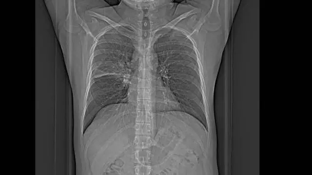 Des radiographies, des tomographies et des biopsies sont utilisées pour diagnostiquer la maladie