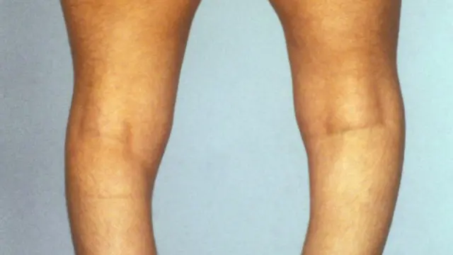 искривленные в результате рахита ноги