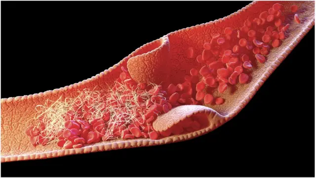 ডিপ ভেইন থ্রম্বোসিস