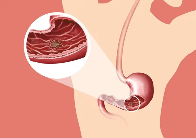 Ulcer