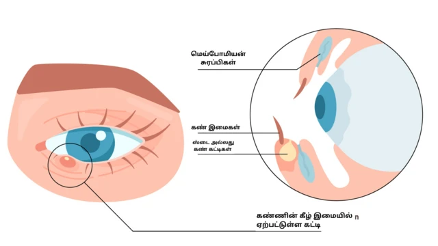 கண்ணில் ஏற்படும் கட்டிகள்