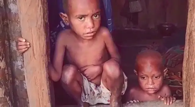 campak di Dogiyai, Papua Tengah