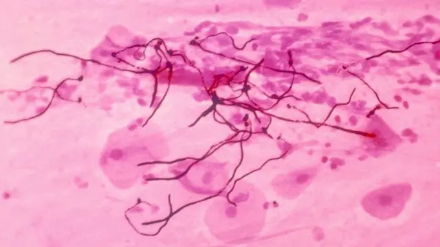 क्यान्डिडा फङ्गस