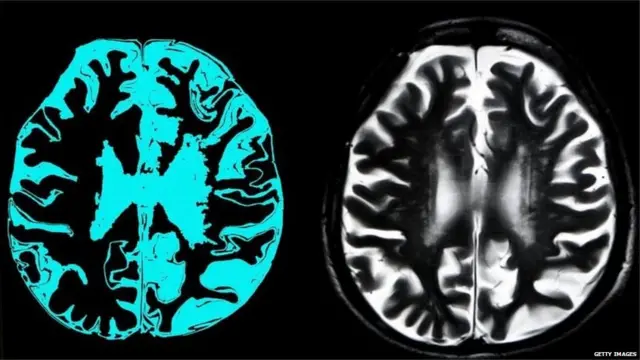 अल्झायमर