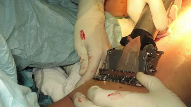 Detalle de la operación. (Foto: Hospital Saint-Loius AP-HP)