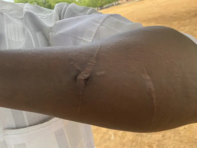 Babangida show im oda hand wia e also suffer fracture 