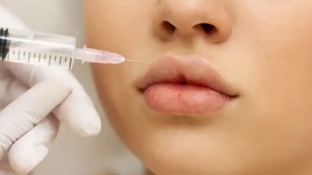लिप फिलर्सचा परिणाम सहा महिने ते एक वर्षापर्यंत राहतो.