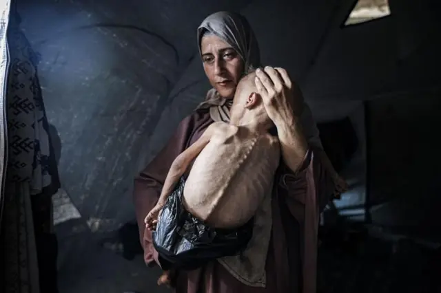 Mulher segura bebê desnutrido