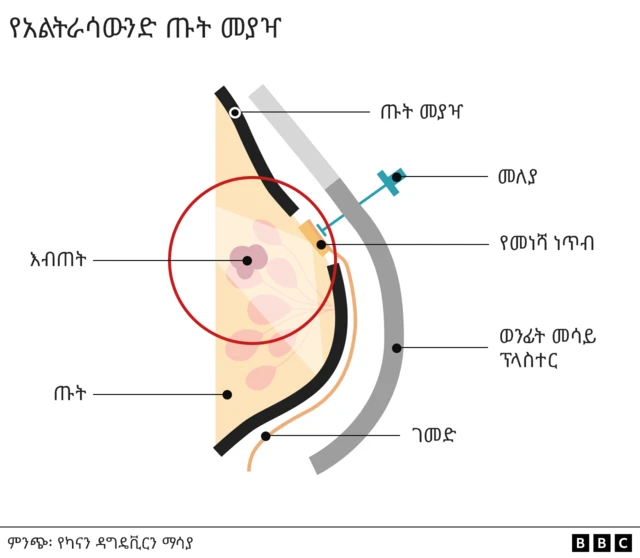 አዲሱ የጡት ካንሰር መመርመሪያ ጡት መያዣ