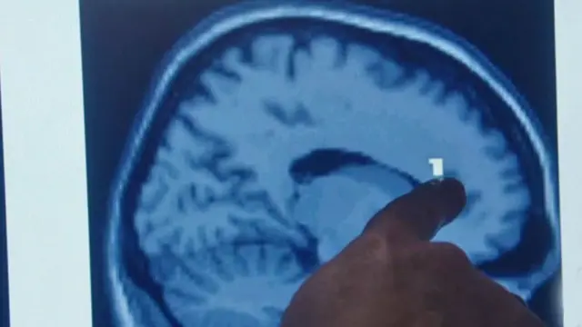 Pantalla con dedo indicando la corteza prefrontal