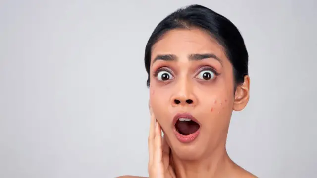 మొటిమలు, ఆరోగ్యం, చర్మవ్యాధి