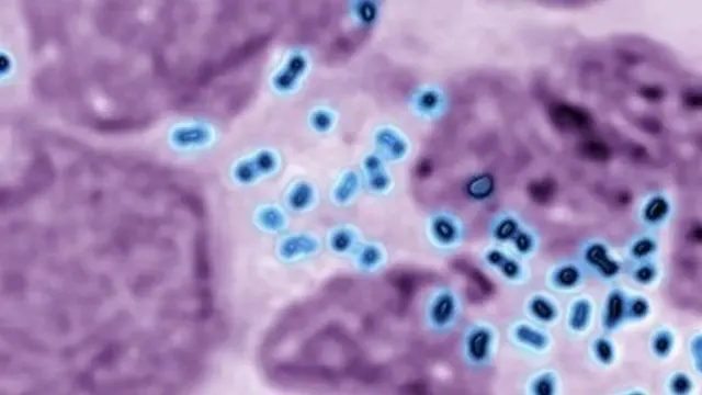 ਗੋਨੋਰੀਆ