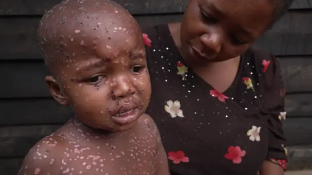 Maymun çiçeği (mpox): Mevcut vakaların çoğu çocuk - BBC News Türkçe