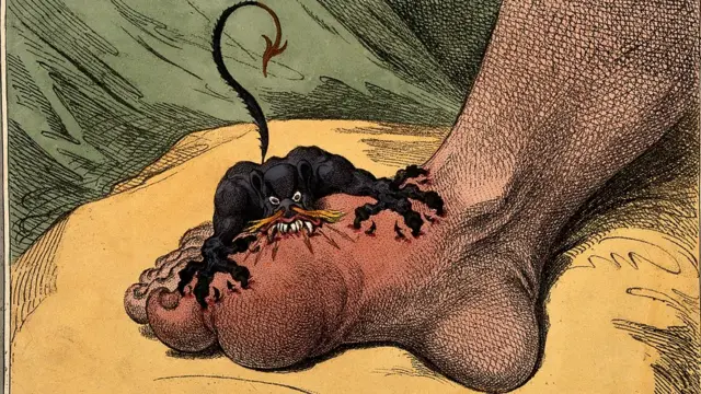 El dolor nos ha atormentado siempre y ha sido representado de una variedad de formas, como ésta, en la que el artista J. Gillray, expresó lo que se siente al sufrir de gota con un demonio atacando un pie (1799).