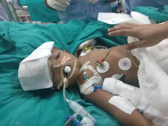 ઓપરેશન બાદ બે પૈકીના એક બાળકનો ફોટોગ્રાફ