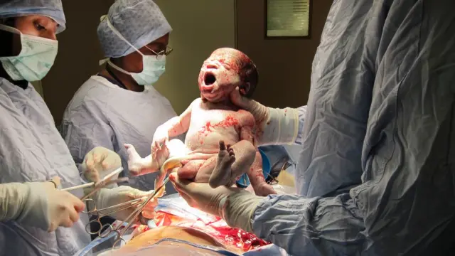 Bayi yang lahir dari proses Caesar.