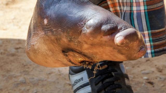 Pie afectado por la lepra de un paciente en Nepal.