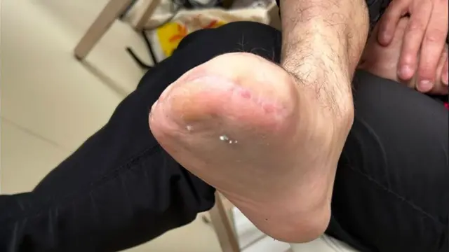 Ikirenge kibyimbye cya Dima 