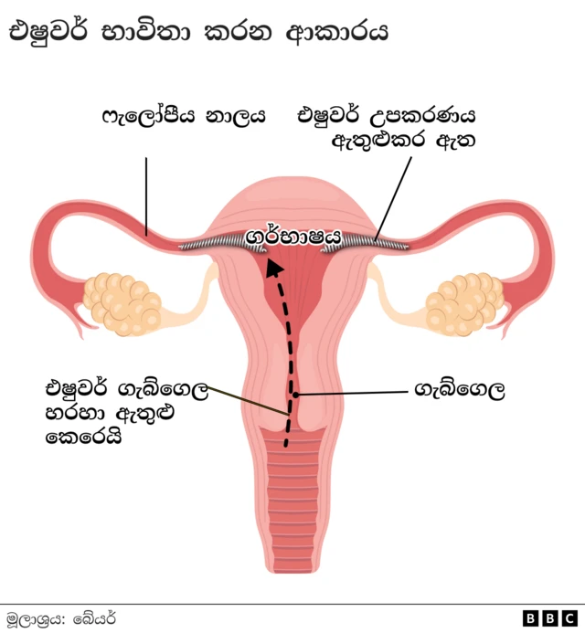 How Essure is deployed