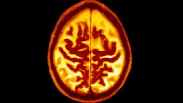 ਅਲਜ਼ਾਈਮਰ