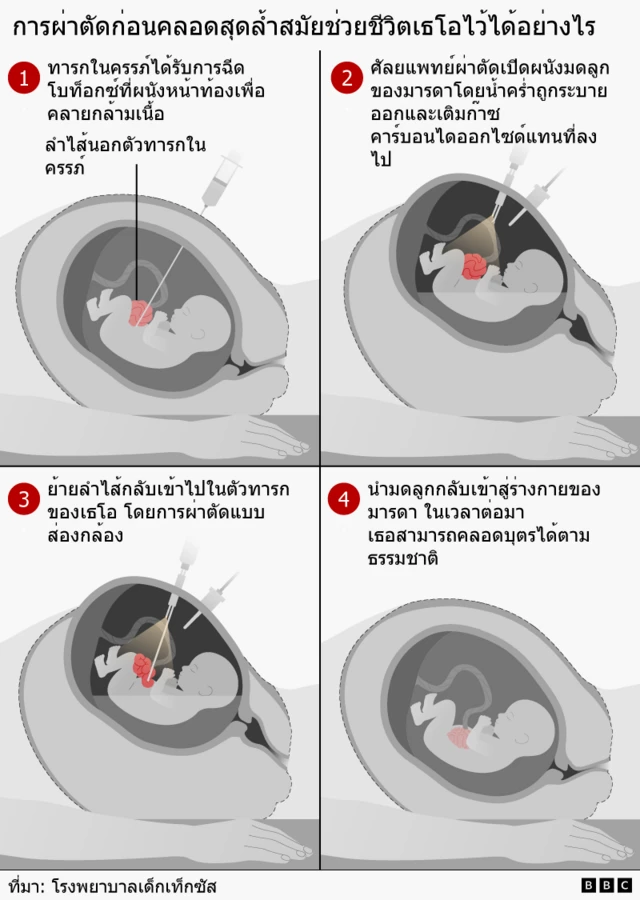 Infographic showing a four-step prenatal surgery. The foetus is given a Botox injection in the abdominal wall to relax the muscles, surgeons temporarily open the womb and use keyhole surgery to move a foetus’s intestines back inside the body before returning the uterus, allowing the pregnancy to continue until the healthy baby is born naturally.