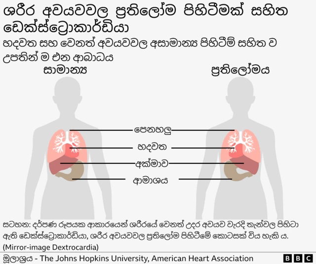 Graphic illustration of congenital disorder with abnormal positioning of the heart and other organs