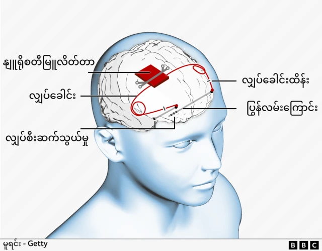 Graphic showing where the device sits in the skull