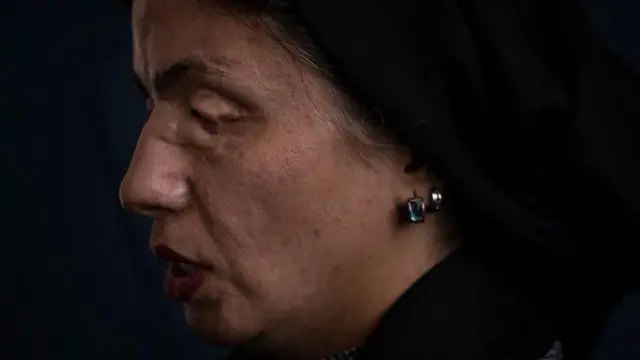 Masoumeh Ataei disiram air keras oleh mertuanya sepuluh tahun yang lalu. Sekarang dia harus mengumpulkan biaya operasi jika ingin mendapatkan kembali penglihatannya.