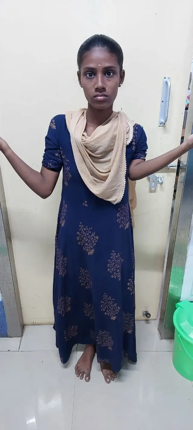 பெண்ணுக்கு 14 செ.மீ. எலும்பை வளரவைத்து அரசு மருத்துவர்கள் சாதனை