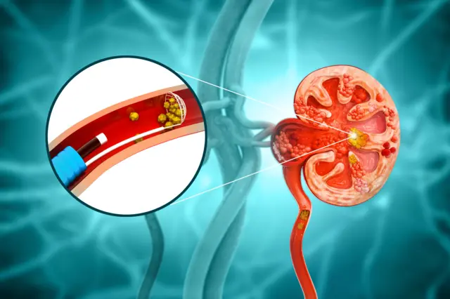 ਗੁਰਦੇ ਵਿੱਚ ਪੱਥਰੀ 
