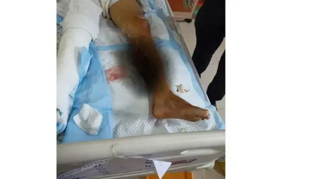 या मुलाच्या शरीरात E.coli आणि Klebsiella चे जंतू शिरल्याचे आढळून आले.