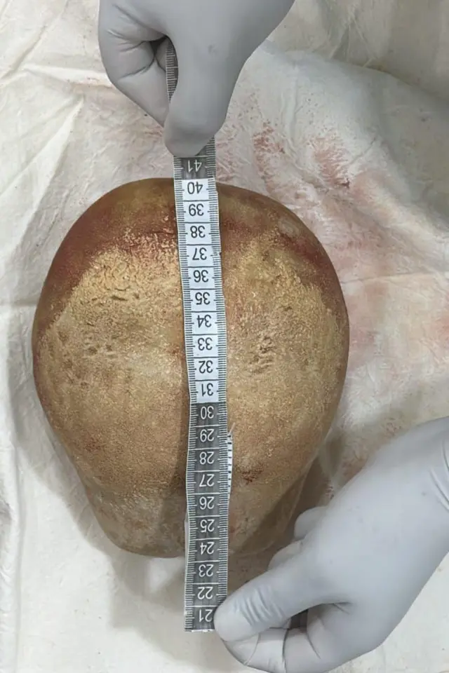 சிறுநீரகப் பையிலிருந்து அகற்றப்பட்ட கல் 