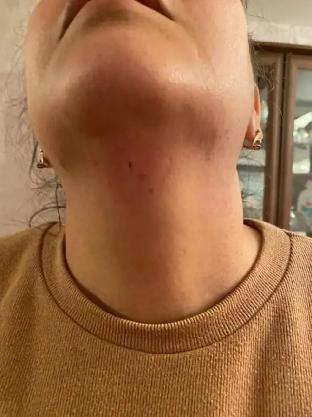 jurnalist, Aytən Məmmədova, boğazında xəsarət izləri