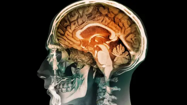 Мозолисте тіло мозок заїкання