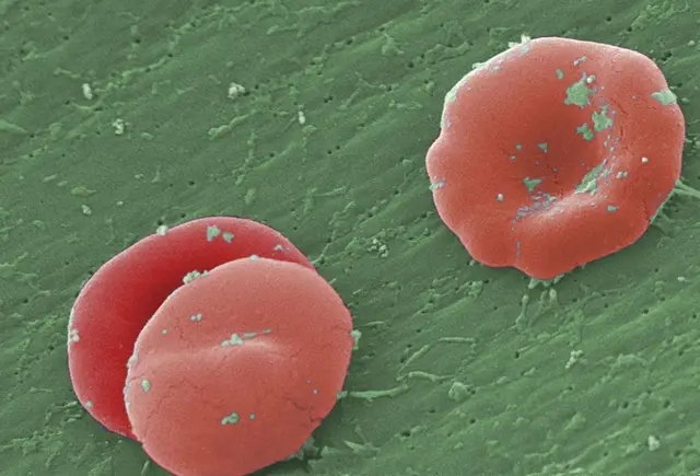 Red blood cell of sickler under microscope