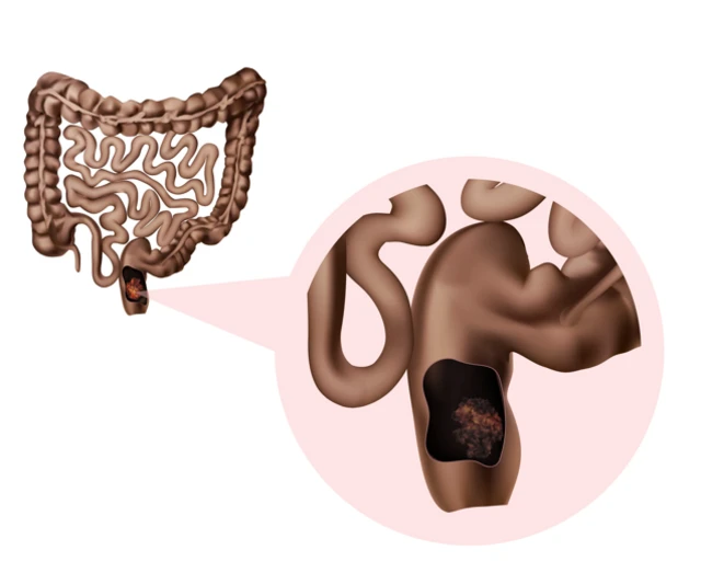 ગુદામાર્ગ, બીબીસી, ગુજરાતી