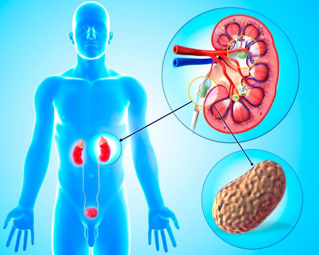 Arte mostra a criação de um cálculo renal