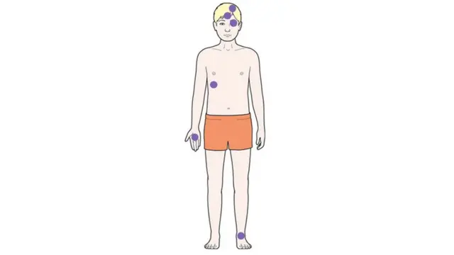 Mapa de partes del cuerpo que pueden desarrollar