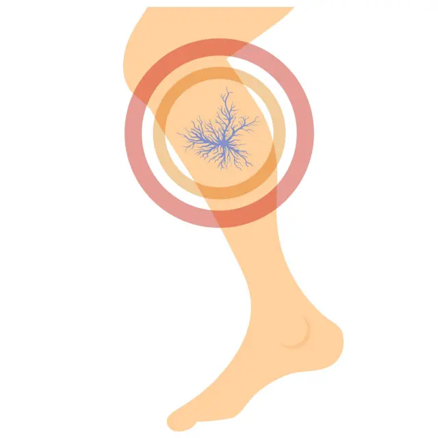 ऑफिसमध्ये तासनतास बसता? व्हेरिकोज व्हेन्सचा धोका कसा वाढतो ते जाणून घ्या