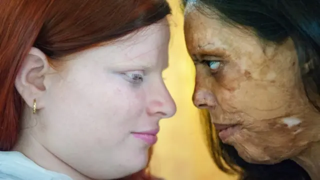 Silvia photographed an acid attack survivor and a woman with albinism together