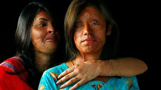 Saira Liaqat (kanan), 22, korban kekerasan asam yang dibakar 4 tahun lalu, berpose bersama teman dan sesama penyintas asam Sabra Sultana (kiri) di Islamabad, 11 Juni 2007.