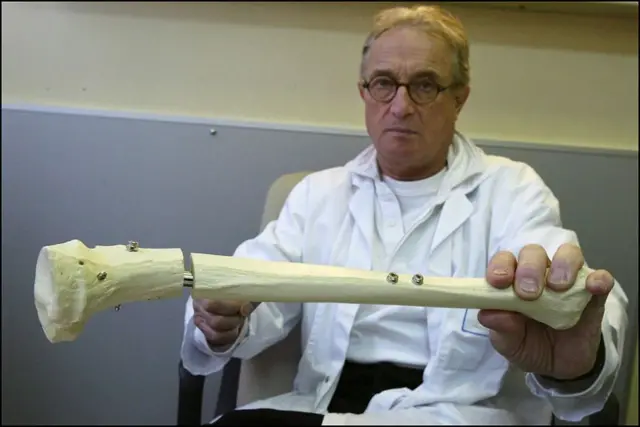 ઑપરેશનમાં હાડકાને તોડીને બંને કટકાને સળિયાની મદદથી છૂટા પડાય છે