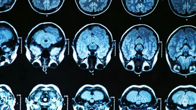 Radiografía del cerebro.