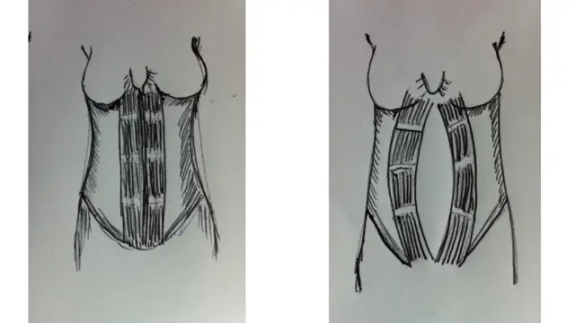 Ilustración de la diástasis de rectos abdominales, cortesía del servicio de Fisioterapia de NHS de Gales